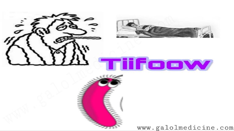 Read more about the article Tiifoow(Typhoid)