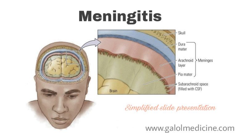 Read more about the article Meningitis