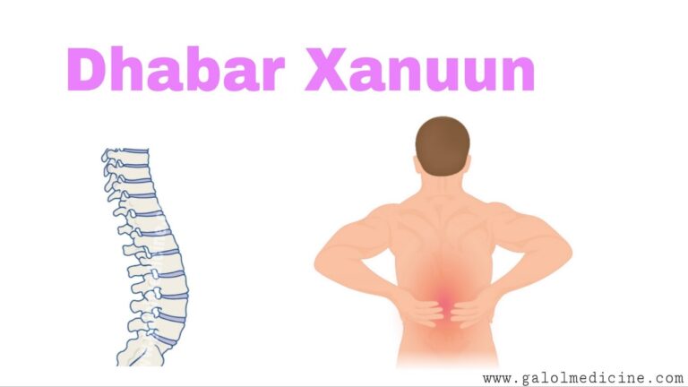 Read more about the article Dhabar Xanuun