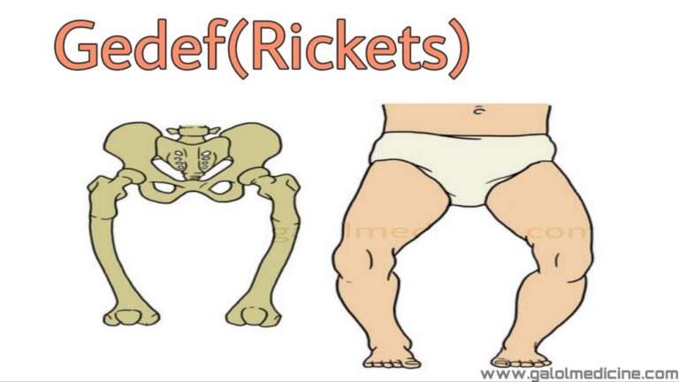 Read more about the article Gedef(Rickets)