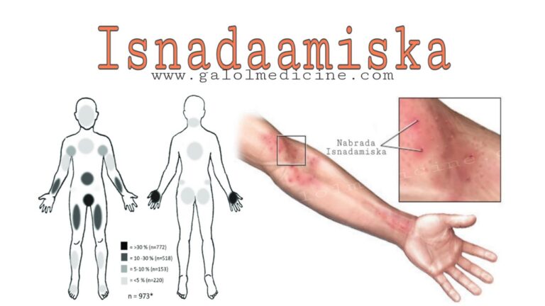 Read more about the article Isnadaamiska(Scabies)
