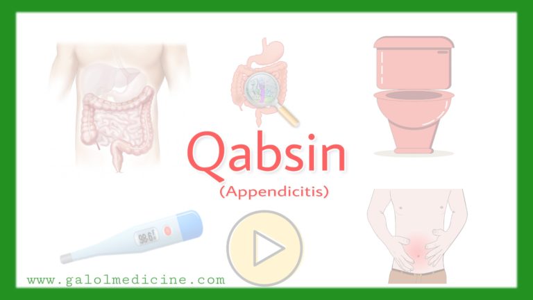 Read more about the article Qabsin(Appendicitis)
