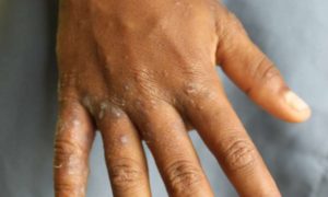 Isnadaamiska(Scabies)